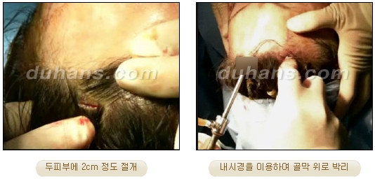 두한성형외과 안티에이징 리프팅 - 엔도타인 리프팅 관련 이미지 24