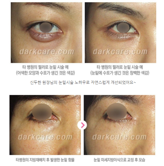 눈밑 다크써클 개선 원리 관련 이미지 15