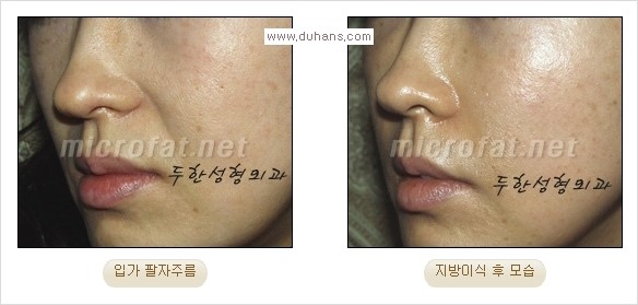 [두한성형외과 경쟁력 주름성형] - [코 옆과 입가에 걸쳐서 형성된 주름을 교정해주는 미세지방이식] 관련 이미지 13