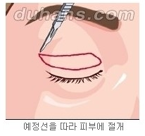 [두한성형외과 안검성형] - [상안검, 하안검] 관련 이미지 3