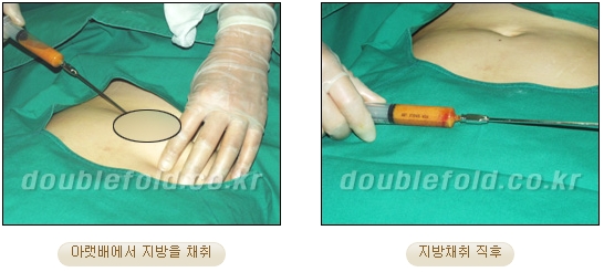 눈성형잘하는곳 두한성형외과 - 겹쌍꺼풀 관련 이미지 30