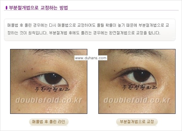 [두한성형외과 NO.1 경쟁력 눈성형] - [풀린 쌍꺼풀 절개법으로 교정하는 방법] 관련 이미지 6