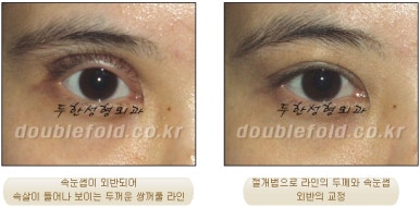 [Duhan Plastic Surgery Eye Surgery] - [Asymmetric Line, Eyelash Eversion, Deep Fixation] image 26