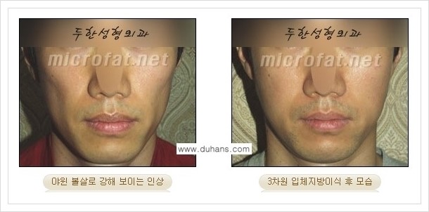 [두한성형외과 경쟁력 볼살지방이식] - [사각턱의 경우, 측면 볼살의 함몰선, 안면비대칭, 남성 야윈볼살 안내] 관련 이미지 13