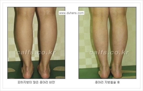 [두한성형외과 경쟁력 멀티종아리성형] - [정교한 미세흡입관 종아리 지방흡입술] 관련 이미지 14