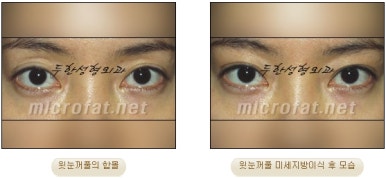 [Doohan Plastic Surgery Autologous Fat Grafting] - [Sunken Eye Fat Grafting] image 37