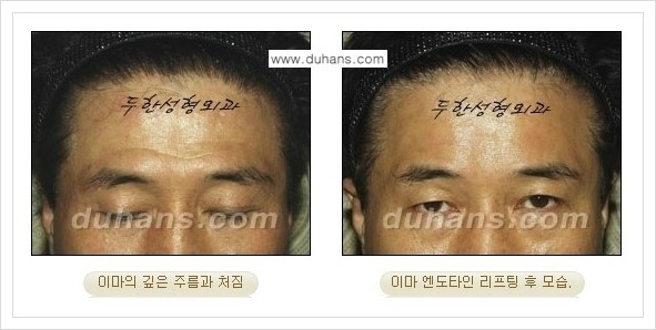 [두한성형외과 경쟁력 주름성형] - [탄력 증대 엔도타인 리프팅 안내] 관련 이미지 23