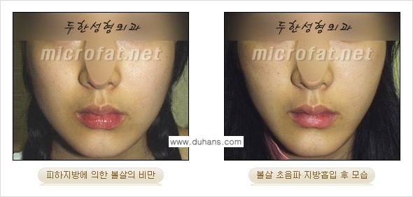 [두한성형외과 경쟁력 지방흡입] - [얼굴, 볼살, 턱살, 턱선의 초음파 지방흡입] 관련 이미지 18