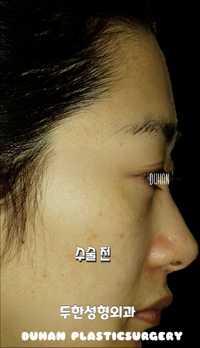 💡 We Design the Face’s ‘Line’ — Not Just Simple Volume Restoration image 1