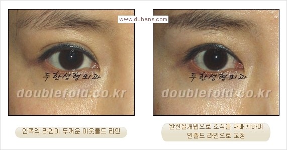 [두한성형외과 경쟁력 눈성형] - [두꺼운 아웃폴드 라인을 인폴드 라인으로 교정] 관련 이미지 10