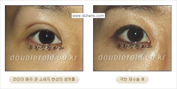 [두한성형외과 경쟁력 쌍꺼풀 재수술, 극한 눈재수술] - [망친 쌍꺼풀을 복원하는 극한 눈재수술] 관련 이미지 10