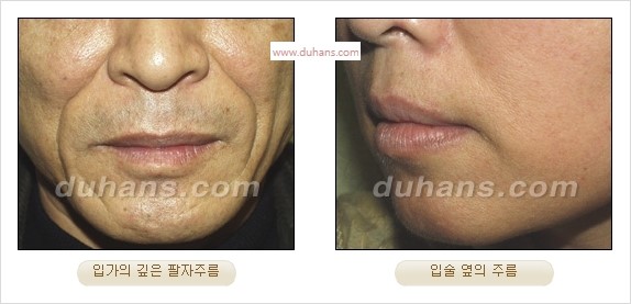 [Dr. 컬럼] - [주름교정을 위한 미세지방이식] 관련 이미지 6