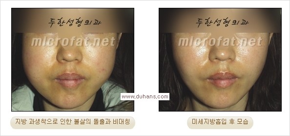 ​[두한성형외과 경쟁력 지방이식] - [지방이식 부작용 이후 마이크로 지방흡입, 마이크로 지방흡입 이후 부작용 없는 지방이식 방법] 관련 이미지 6