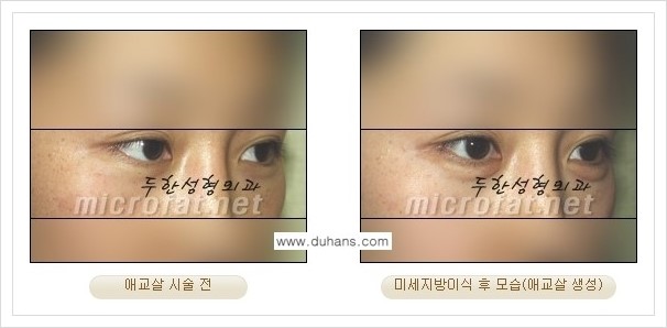 [두한성형외과 경쟁력 눈밑성형] - [눈밑 다크써클과 눈밑 애교살과의 관계] 관련 이미지 10