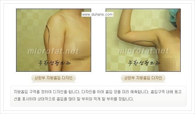 [두한성형외과 경쟁력 맞춤 바디성형] - [간편한 아랫배, 윗배, 허리, 옆구리살, 허벅지, 엉덩이, 복부지방흡입술, 팔뚝(상완부) 지방흡입술 안내] 관련 이미지 4