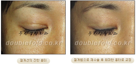 [두한성형외과 쌍커풀수술] - [눈성형 방법에 대한 자주하는 질문과 답변] 관련 이미지 25