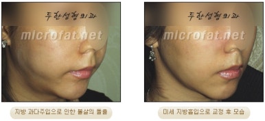 [두한성형외과 얼굴지방이식] - [볼지방이식] 관련 이미지 43