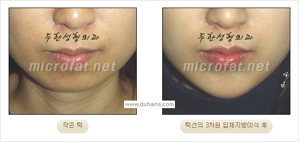 ⁠⁠[두한성형외과 경쟁력 미세지방이식] - [턱 미세지방이식 - 안면윤곽 교정 안내] 관련 이미지 21