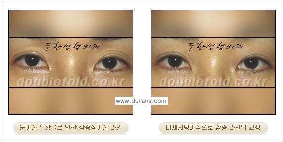 [두한성형외과 경쟁력 눈성형] - [미세지방이식으로 삼중 라인의 교정 방법 안내] 관련 이미지 2
