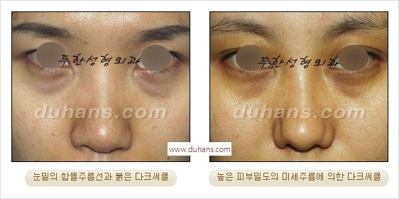 [두한성형외과 경쟁력 안검성형] - [젊은 눈매 안검성형의 여러 가지 방법 안내] 관련 이미지 51