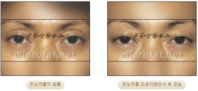 [Doohan Plastic Surgery Autologous Fat Grafting] - [Sunken Eye Fat Grafting] image 21