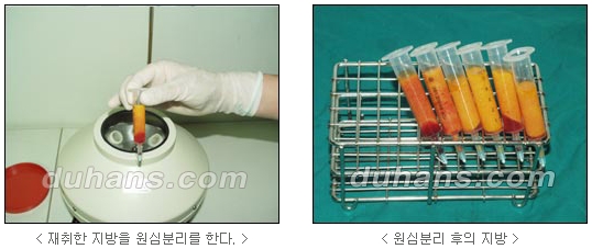 [두한성형외과 얼굴자가지방이식] - [코지방이식] 관련 이미지 6