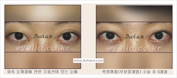 [두한성형외과 경쟁력 눈성형] - [퀵쌍꺼풀(부분절개법) 안내] 관련 이미지 7