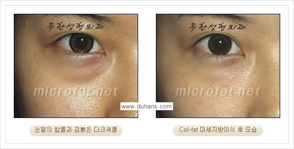 [두한성형외과 경쟁력 눈밑성형] - [눈밑 다크써클과 눈밑 함몰주름의 최적화 교정방법 안내] 관련 이미지 22