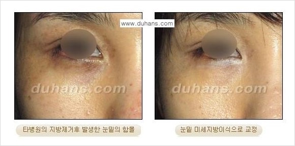 [두한성형외과 경쟁력 눈밑성형] - [과도한 눈밑지방제거의 부작용 후 눈밑지방재배치] 관련 이미지 1