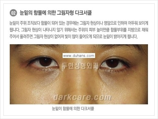 [두한성형외과 경쟁력 눈밑성형] - [다크써클의 종류] 관련 이미지 3