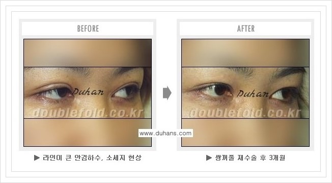 [두한성형외과 경쟁력 쌍꺼풀 재수술, 극한 재수술] - [과한 눈매교정 안내] 관련 이미지 6