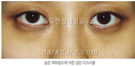 Duhan Plastic Surgery Dark Circle Improvement - What Causes Dark Circles? What Types of Dark Circles Are There? image 19
