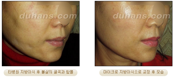 [두한성형외과 얼굴자가지방이식] - [볼살, 이마, 측두부] 관련 이미지 38