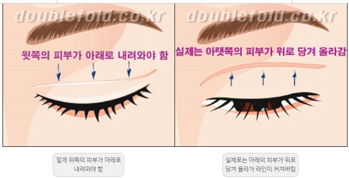 [Duhan Plastic Surgery Double Eyelid Revision] - [Thick Double Eyelid Line] image 4