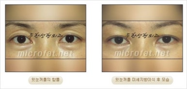 [두한성형외과 얼굴자가지방이식] - [지방이식 과정] 관련 이미지 27