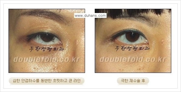 [두한성형외과 경쟁력 쌍꺼풀 재수술, 극한 재수술] - [망친 눈(쌍꺼풀) 복원수술과 일반 쌍꺼풀 재수술과의 차이점] 관련 이미지 8