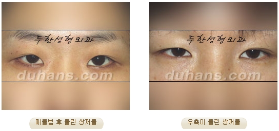 두한성형외과 눈재수술 - 쌍꺼풀 재수술 방법 관련 이미지 15