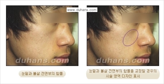 [두한성형외과 경쟁력 미세지방이식] - [귀족수술 입체 미세지방이식] 관련 이미지 8