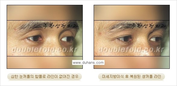 [두한성형외과 NO.1 눈성형] - [함몰된(꺼진) 눈꺼풀에서 쌍꺼풀 라인 교정 3.] 관련 이미지 13