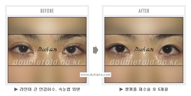 [두한성형외과 Dr. 컬럼] - [쌍꺼풀 재수술(눈 재수술)의 목적] 관련 이미지 3