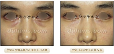 두한성형외과 눈밑성형 - 눈밑지방제거, 눈밑주름, 눈밑지방재배치 관련 이미지 70