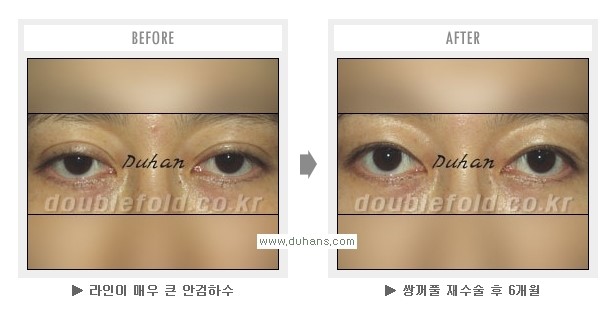 [두한성형외과 Dr. 컬럼] - [쌍꺼풀 재수술(눈 재수술)의 목적] 관련 이미지 4