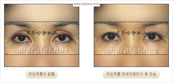 [두한성형외과 경쟁력 눈성형 리더] - [윗눈꺼풀 함몰( #꺼진눈꺼풀) 미세지방이식과 상안검성형]#꺼진눈성형 , #눈위함몰 관련 이미지 8