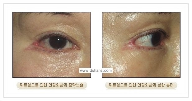 [두한성형외과 경쟁력 쌍꺼풀 재수술, 극한 재수술] - [뒤트임 수술에 대한 안내] 관련 이미지 5