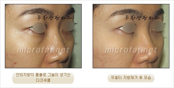 [두한성형외과 쌍커풀수술] - [눈성형 방법에 대한 자주하는 질문과 답변] 관련 이미지 177