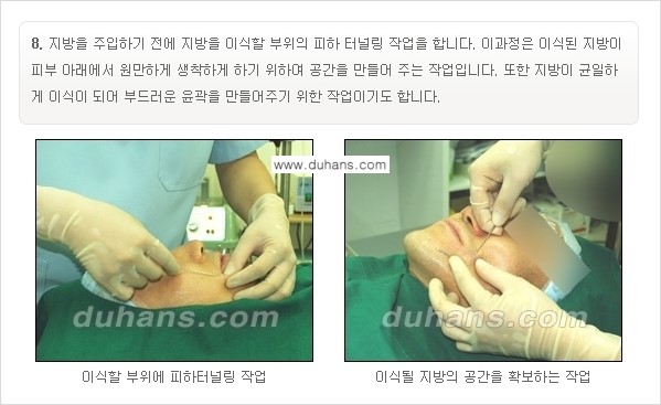 [두한성형외과 경쟁력 미세지방이식] - [부드럽고 아름다운 얼굴선 얼굴 미세지방이식 과정] 관련 이미지 8