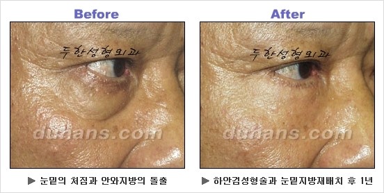 [두한성형외과 경쟁력 동안성형 리더] - ​[미간주름, 이마주름, 안검성형, 이마거상술, 눈썹거상술] 관련 이미지 112