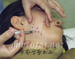 [두한성형외과 보톡스] - [사각턱 보톡스 시술 안내] 관련 이미지 9