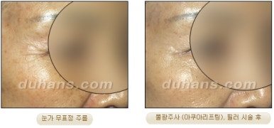 [Wrinkle Correction, Duhan Plastic Surgery] - [Wrinkle Botox, Wrinkle Filler, Wrinkle Fat Grafting] image 23