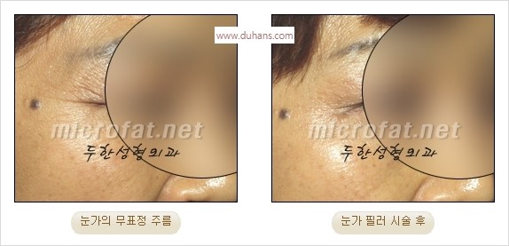 [두한성형외과 경쟁력 Quick성형] - [주름교정을 위한 필러 시술] 관련 이미지 12
